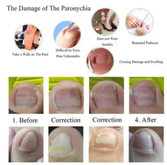 Parche corrector de ortodoncia para uñas encarnadas, inflamaciones y cortaúñas para manicura.